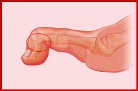 صور متنوعة الاصبع المطرقة Hammer Toe5 Size:5.80 Kb Dim: 271 x 179 Size: Kb Dim: x